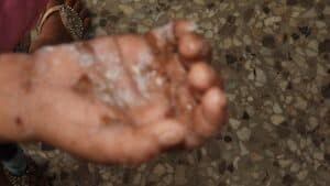 Childs Chemical Burn at the Hospital Nacional